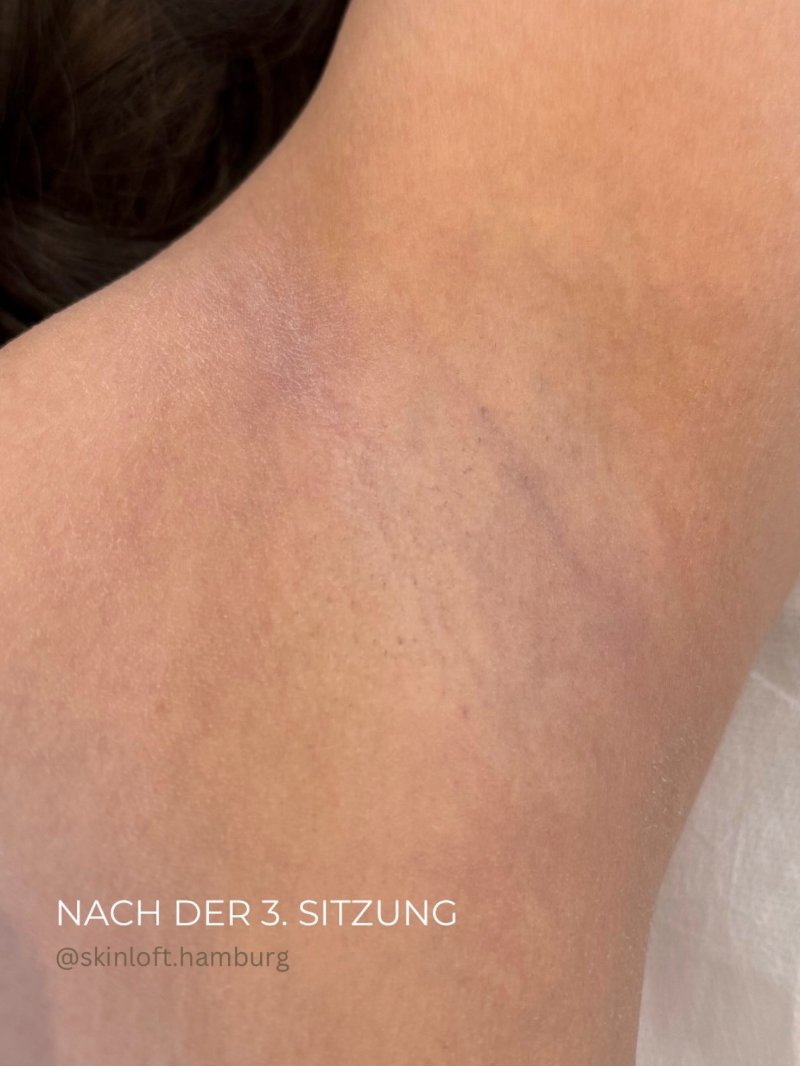 Ergebnis der Laser-Haarentfernung an der Achsel nach der 3. Sitzung bei Skinloft Hamburg in St. Georg